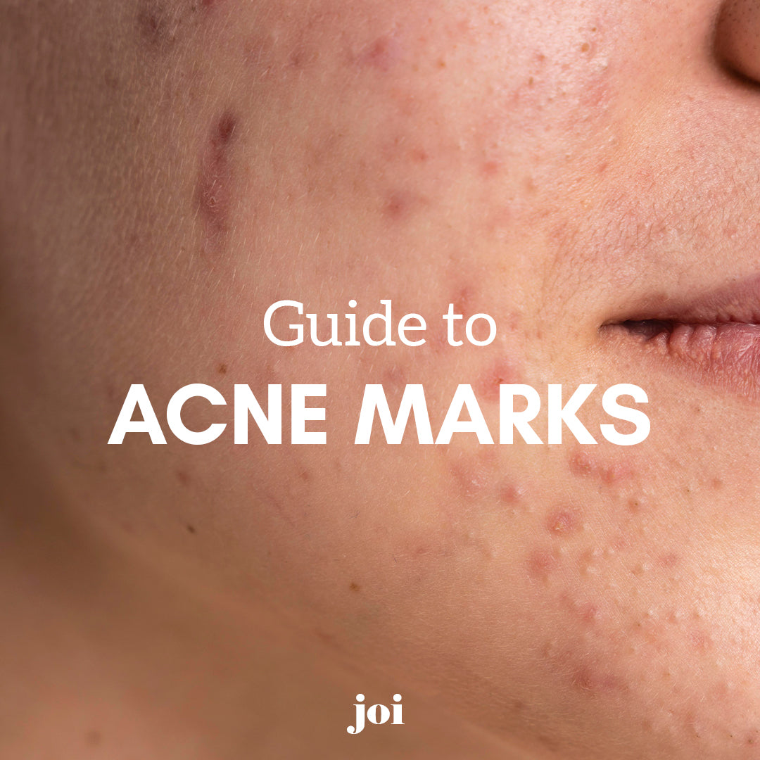 GUIDE TO ACNE MARKS